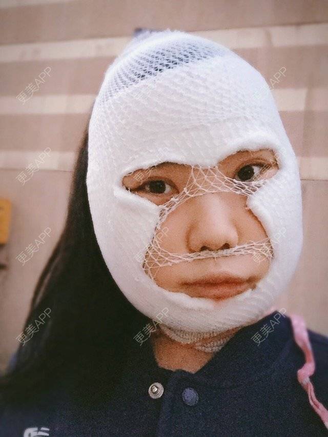 更美 - 陆小鸭o的经验 | 颧骨颧弓内推 | 下颌角 | 重庆