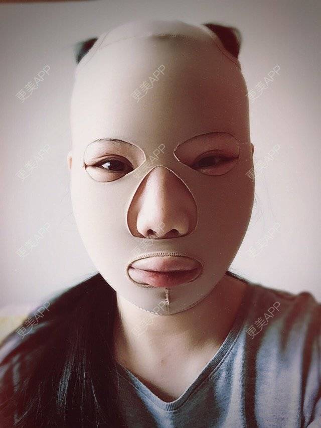 更美 - 陆小鸭o的经验 | 颧骨颧弓内推 | 下颌角 | 重庆