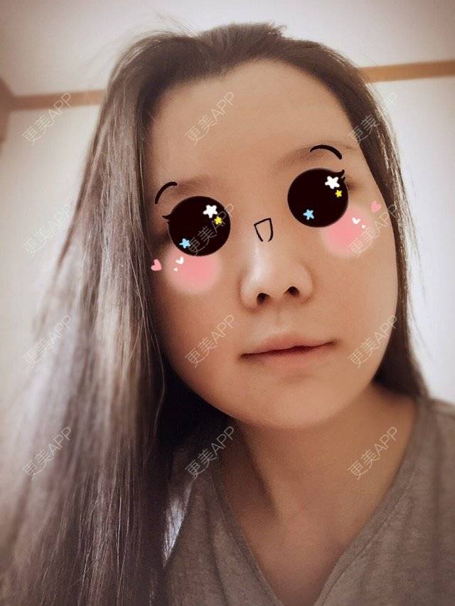 更美 - 陆小鸭o的经验 | 颧骨颧弓内推 | 下颌角 | 重庆