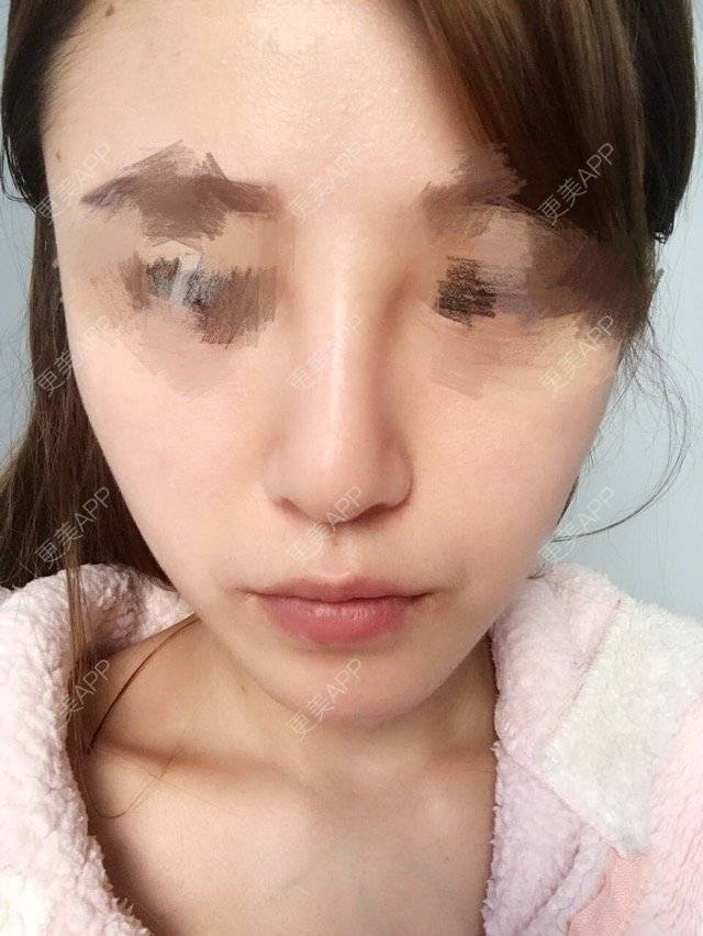 更美 - 我是宝宝妞咖的经验 | 鼻子 | 福州