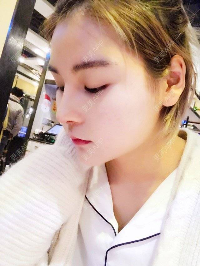 更美 - 喜宝i的下颌角经验 | 超长下颌角 | 面部轮廓 | 下颌角 | 西安