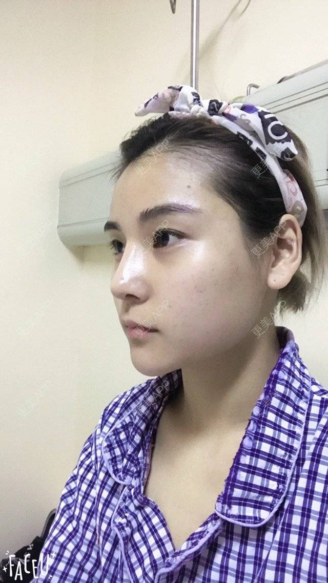 更美 - 喜宝i的下颌角经验 | 超长下颌角 | 面部轮廓 | 下颌角 | 西安