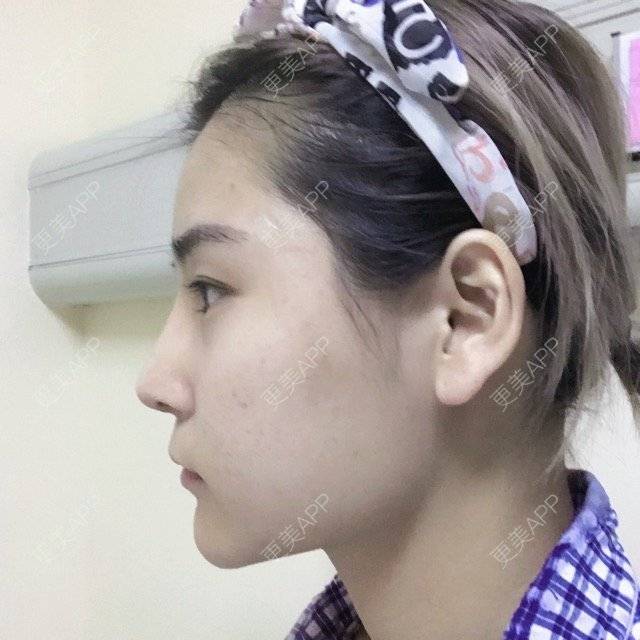 更美 - 喜宝i的下颌角经验 | 超长下颌角 | 面部轮廓 | 下颌角 | 西安