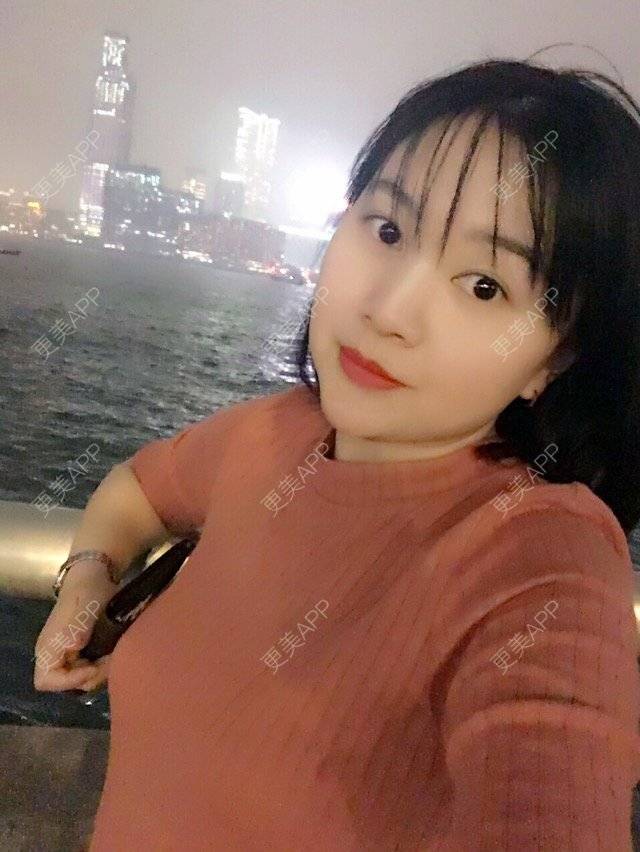 更美 - belle戴的玻尿酸太阳穴经验 | 美购日记 | 玻尿酸太阳穴 | 上海