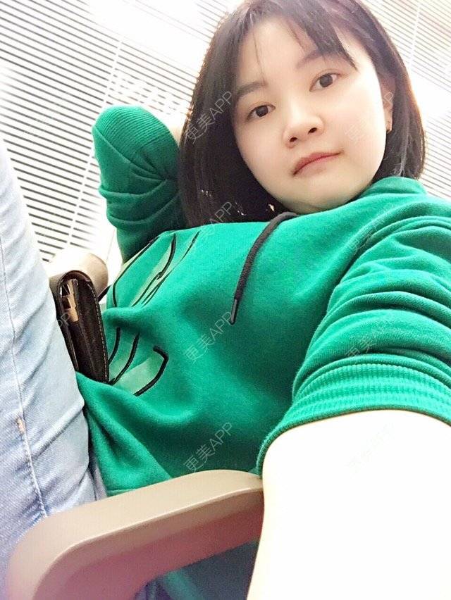 更美 - belle戴的玻尿酸太阳穴经验 | 美购日记 | 玻尿酸太阳穴 | 上海