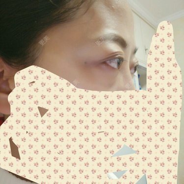 眼睛高度近视好多年了眼球突出很严重又有轻微甲亢这