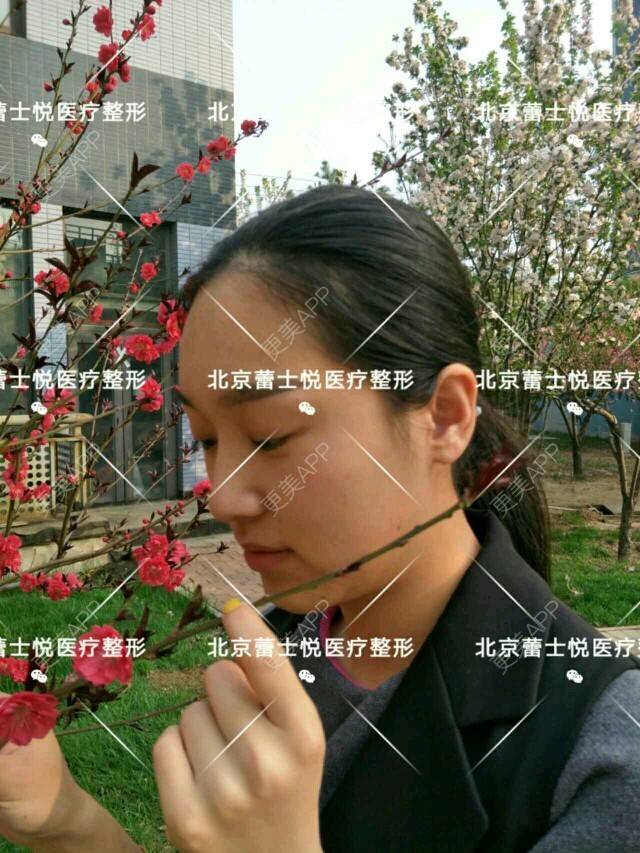 更美 - 北京蕾士悦容医疗美容的全切双眼皮经验 | 全切双眼皮