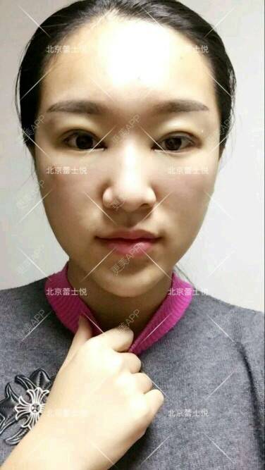 更美 - 北京蕾士悦容医疗美容的全切双眼皮经验 | 全切双眼皮