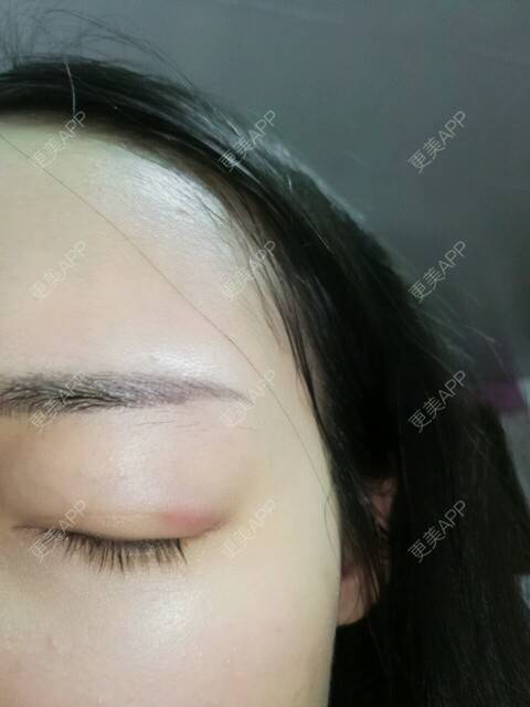 更美 - 更美用户ukHBS7uM9t的经验 | 埋线双眼皮术后 | 双眼皮 | 广州