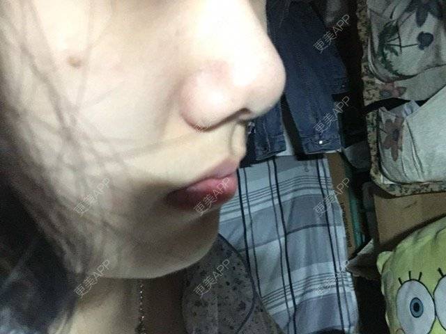 更美 - 更美用户hc4ZqJYZQe的经验 | 鼻综合手术 | 缩小鼻头鼻翼 | 鼻部整形 | 天津