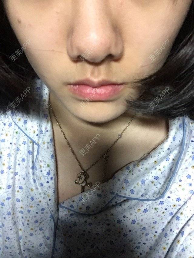 更美 - 更美用户hc4ZqJYZQe的经验 | 鼻综合手术 | 缩小鼻头鼻翼 | 鼻部整形 | 天津