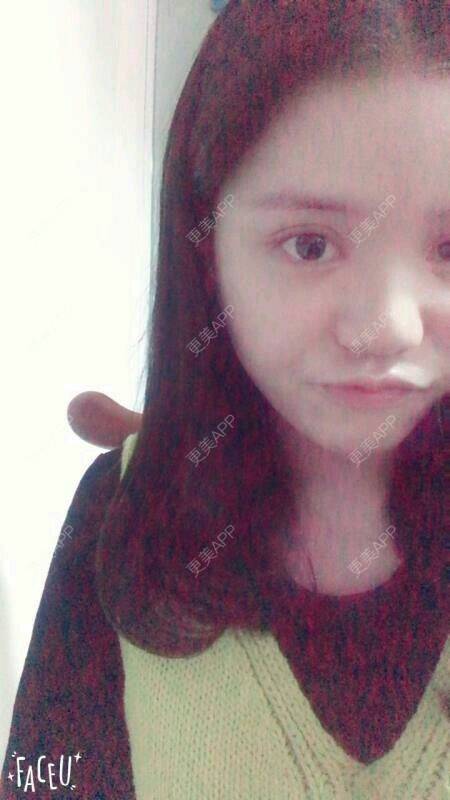 更美 - 我不是萌妹纸的全切双眼皮经验 | 脸颊吸脂 | 自体脂肪填充面部手术 | 全切双眼皮 | 深圳