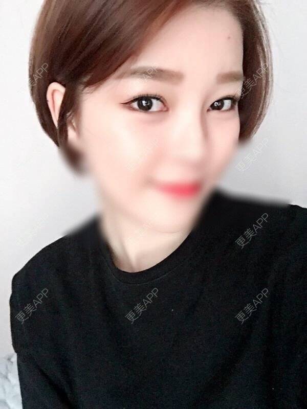 更美 - miyoa的眼睑下至经验 | 韩国绮林整形外科 | 眼睑下至 | 首尔
