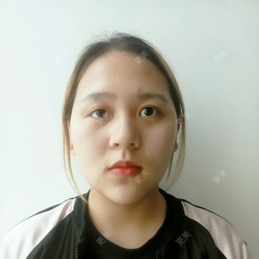 自体脂肪全面部填充