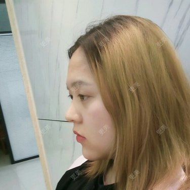 自体脂肪全面部填充