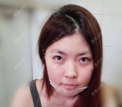 更美 - 蕊蕊要变美的轮廓套餐经验 | 韩国绮林整形外科 | 轮廓套餐 | 首尔