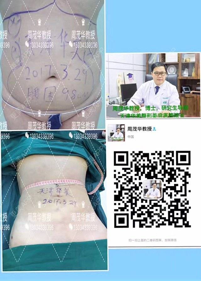 更美 - CherishBabe旋的经验 | 腰腹部吸脂 | 吸脂瘦大腿