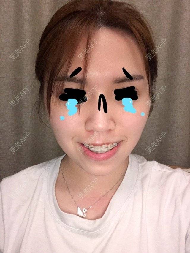 更美 - YANYANBB🤗的经验 | 骨性龅牙 | 上颌牙槽骨前突 | 上下颌 | 深圳