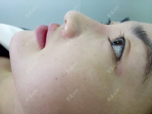 更美 - 宾仁 医生的玻尿酸经验 | 玻尿酸 | 湘潭