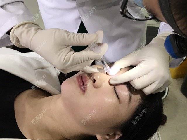 更美 - 宾仁 医生的玻尿酸经验 | 玻尿酸 | 湘潭