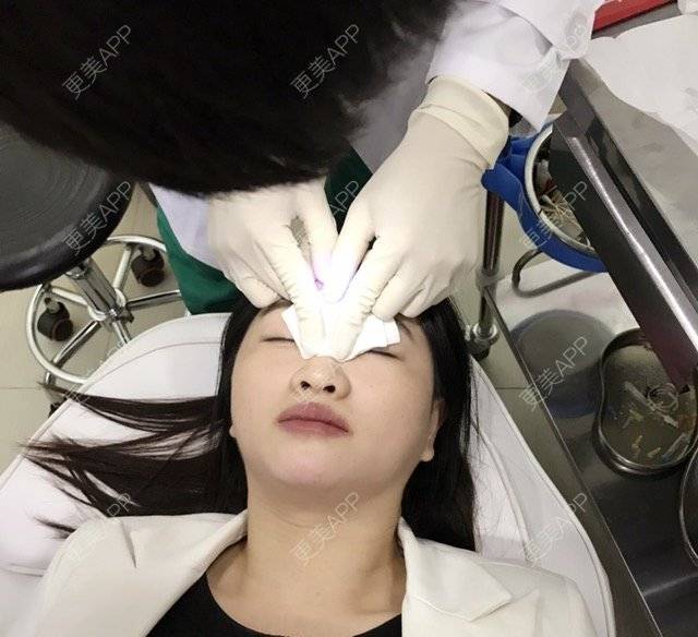 更美 - 宾仁 医生的玻尿酸经验 | 玻尿酸 | 湘潭