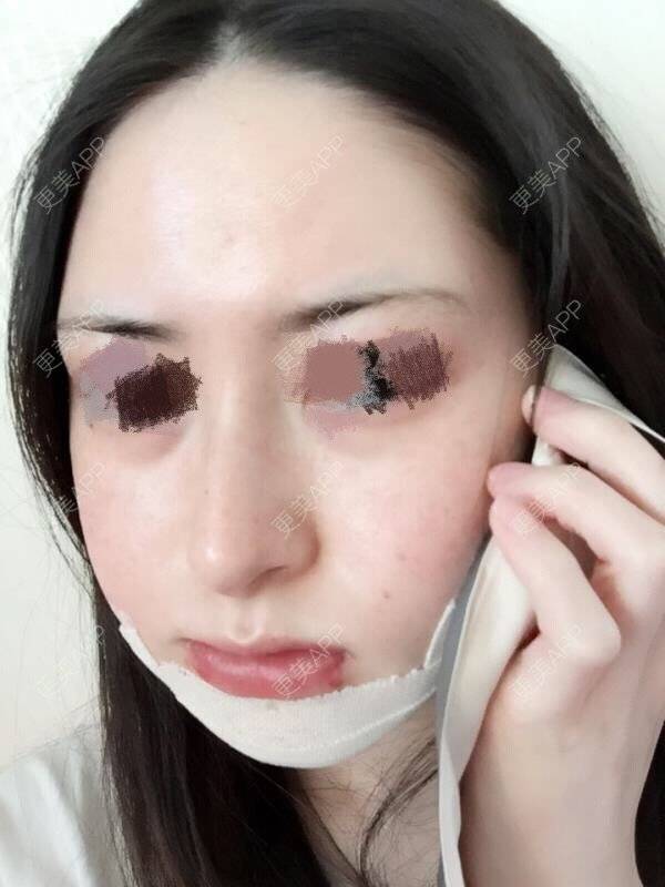 更美 - 小佳佳佳的经验 | 韩国绮林整形外科 | 首尔