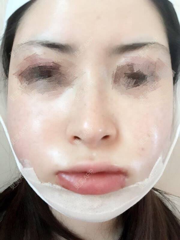 更美 - 小佳佳佳的经验 | 韩国绮林整形外科 | 首尔