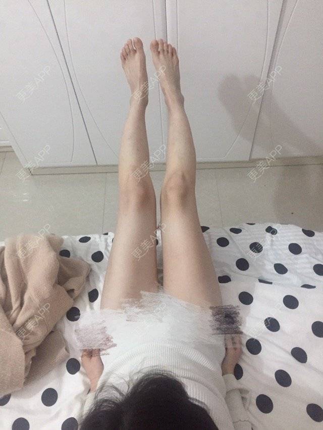 更美 - 我怎么这么美的经验 | 吸脂瘦腿 | 瘦身美体 | 广州