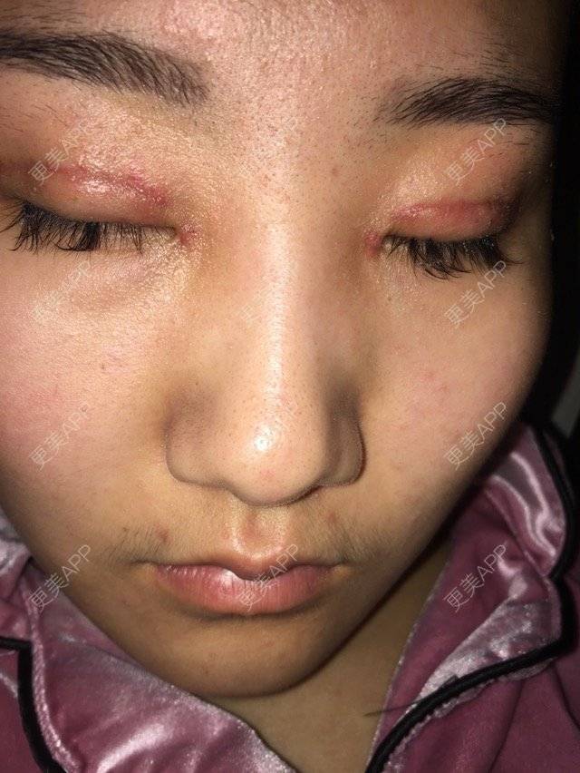 更美 - Cici .周的经验 | 全切双眼皮修复 | 巴彦淖尔