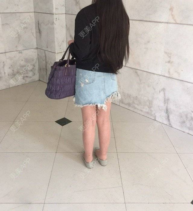 更美 - 慢漫曼小姐的吸脂瘦大腿经验 | 宁波 | 吸脂瘦大腿