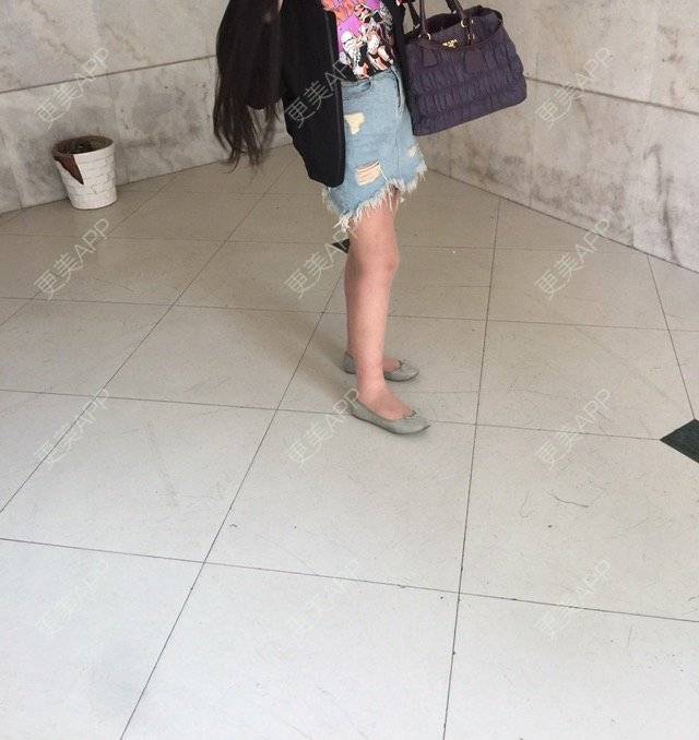 更美 - 慢漫曼小姐的吸脂瘦大腿经验 | 宁波 | 吸脂瘦大腿