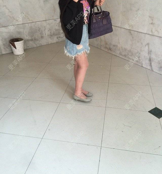 更美 - 慢漫曼小姐的吸脂瘦大腿经验 | 宁波 | 吸脂瘦大腿