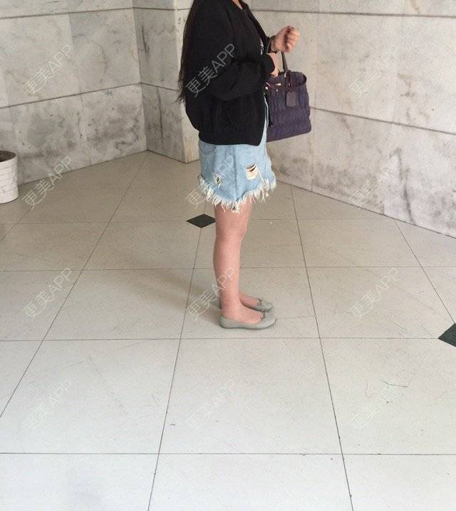 更美 - 慢漫曼小姐的吸脂瘦大腿经验 | 宁波 | 吸脂瘦大腿