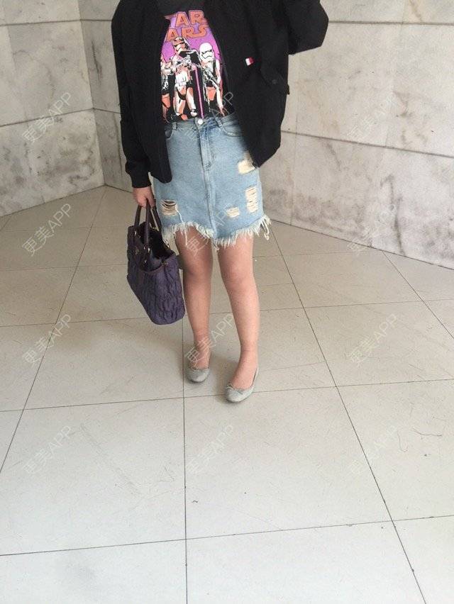 更美 - 慢漫曼小姐的吸脂瘦大腿经验 | 宁波 | 吸脂瘦大腿