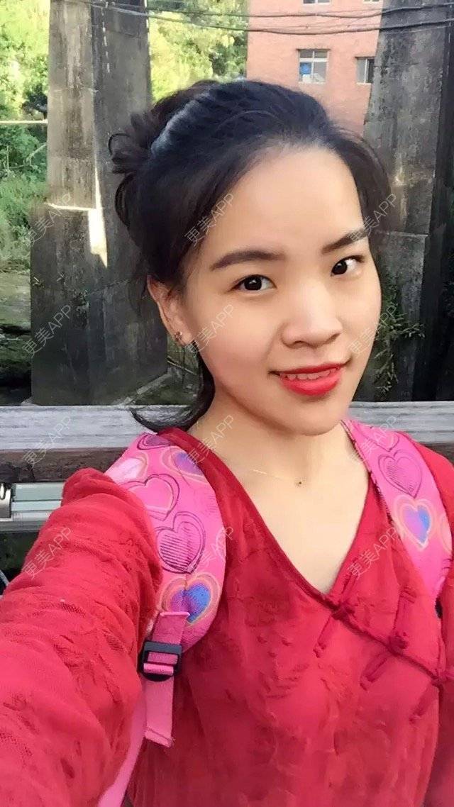 更美 - 更美用户7781927869的经验 | 鼻部整形 | 双眼皮埋线