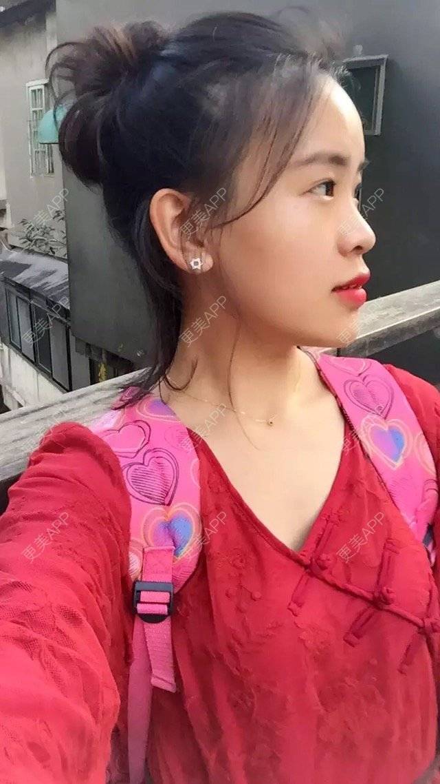 更美 - 更美用户7781927869的经验 | 鼻部整形 | 双眼皮埋线