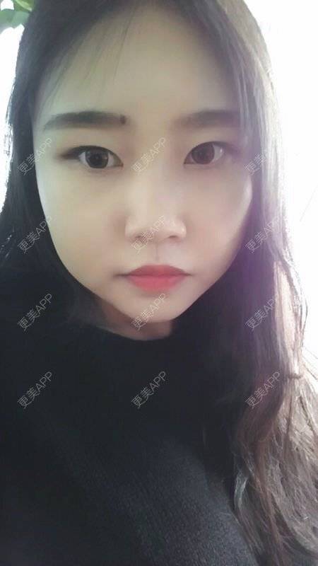更美 - 丽丽安的轮廓套餐经验 | 韩国绮林整形外科 | 轮廓套餐 | 首尔