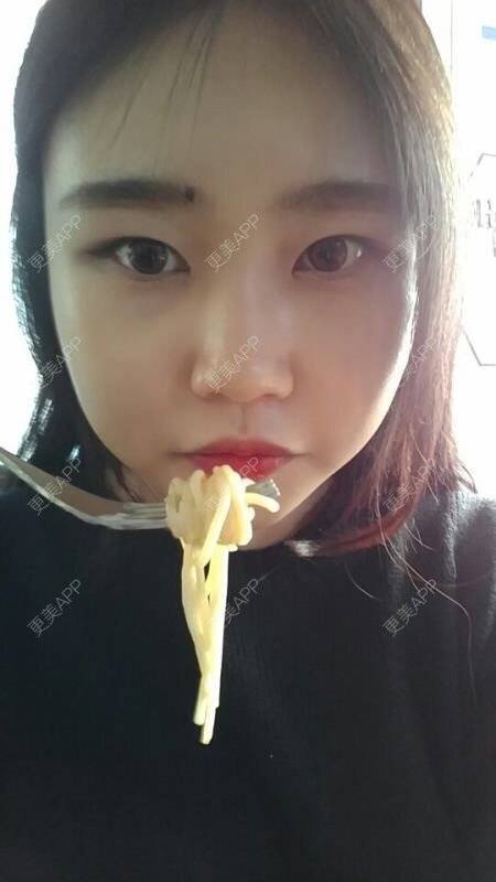 更美 - 丽丽安的轮廓套餐经验 | 韩国绮林整形外科 | 轮廓套餐 | 首尔