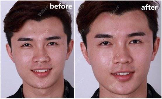 更美 - 笑笑笑水阁的玻尿酸额头经验 | 玻尿酸额头 | 长沙