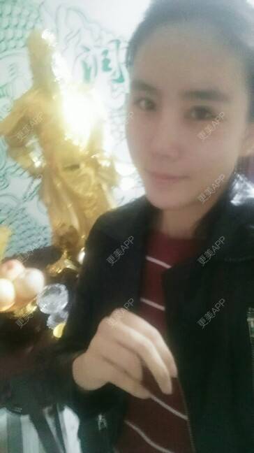 更美 - 更美用户YdB0Dcw3Me的肋软骨隆鼻经验 | 肋软骨隆鼻 | 威海