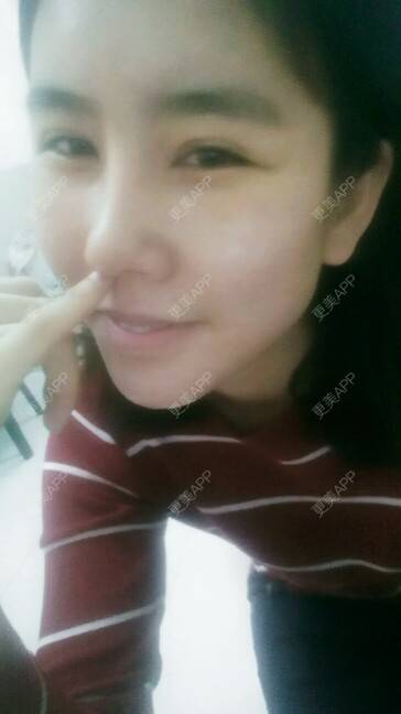 更美 - 更美用户YdB0Dcw3Me的肋软骨隆鼻经验 | 肋软骨隆鼻 | 威海