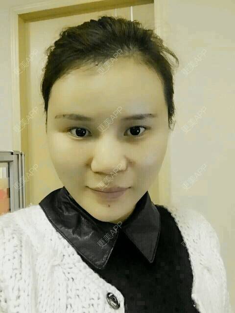 更美 - 黄丽华 医生的自体脂肪全面部填充经验 | 自体脂肪全面部填充 | 深圳