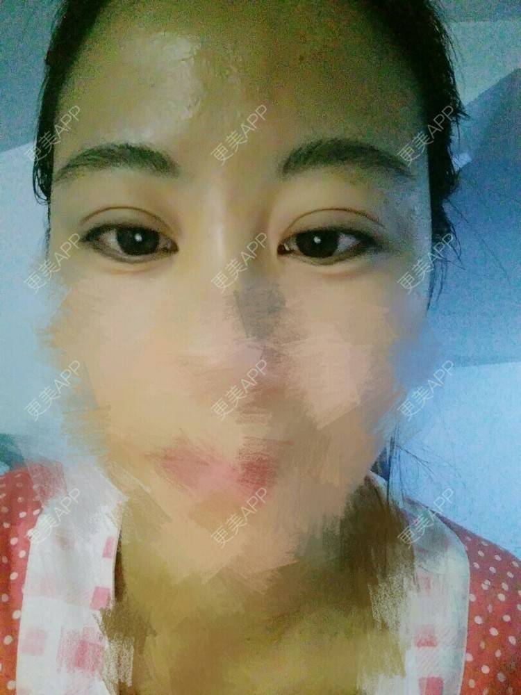 更美 - 更美用户55548629的经验 | 眼部整形 | 眼部整形1