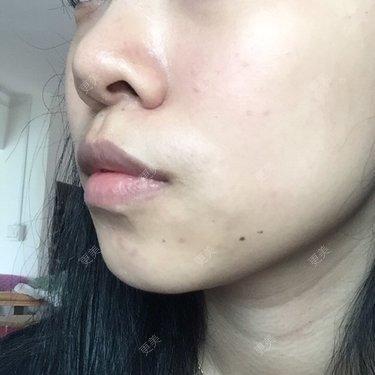 嘴凸出人中肉比较厚牙齿整齐有点外凸感觉牙龈也属于比较凸只戴牙套会