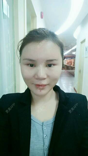 更美 - 黄丽华 医生的自体脂肪全面部填充经验 | 自体脂肪全面部填充 | 深圳