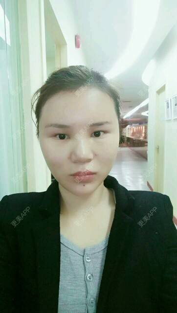 更美 - 黄丽华 医生的自体脂肪全面部填充经验 | 自体脂肪全面部填充 | 深圳