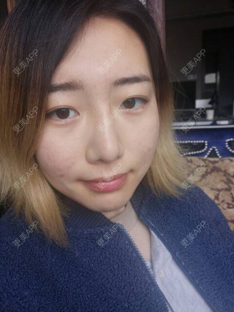 更美 - Cold婷的经验 | 皮肤美容 | 脸部痘痘 | 长沙