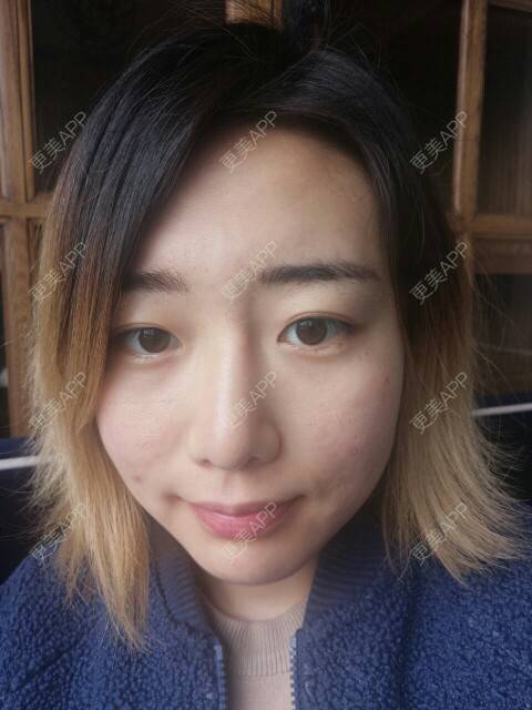 更美 - Cold婷的经验 | 皮肤美容 | 脸部痘痘 | 长沙