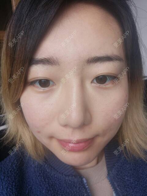 更美 - Cold婷的经验 | 皮肤美容 | 脸部痘痘 | 长沙