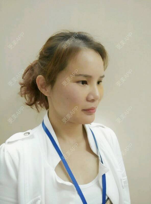更美 - 黄丽华 医生的自体脂肪全面部填充经验 | 自体脂肪全面部填充 | 深圳